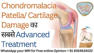 Chondromalacia Patella का सबसे Advanced Treatment, High Grade Chondral Loss Patella Cartilage Damage