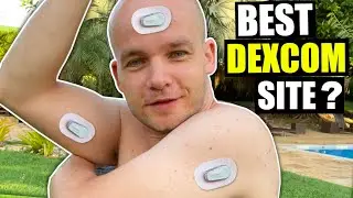7 Best Sites for Dexcom G6 Sensor Placement
