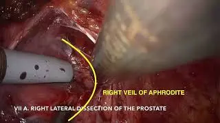 #319 Nerve Sparing Robot-Assisted Radical Prostatectomy with HUGO RAS System... Dr. Nicola Frego