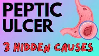 Shocking Secrets: The Real Causes Behind Peptic Ulcers - 3 HIDDEN CAUSES