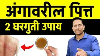अंगावर पित्त उठतंय? जाणून घ्या याचे उपाय | शितपित्त असेल तर काय काळजी घ्यावी | Dr Nagarekar |