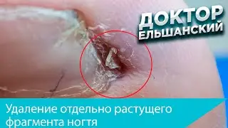 Удаление отдельно растущих фрагментов ногтя после радиоволновой операции