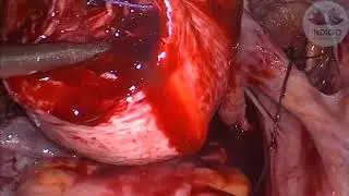 Laparoscopic myomectomy with temporary uterine artery ligation (no vasopressin)