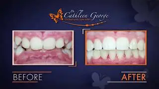 Custom Content Example: Orthodontic Before & After
