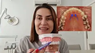 FRENECTOMIA - SERÁ QUE PRECISO FAZER?