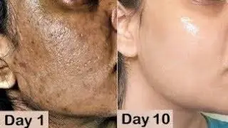 Day 14-Guaranteed Skin Repair 👍👍Dark Spots, Pigmentation, Dark Circle, Skin Whitening
