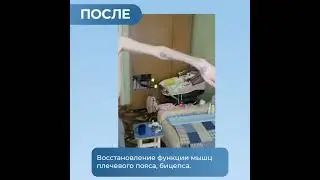Плечевое нервное сплетение. Результат лечения