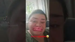 Ботокс на моих плечах😅😅 