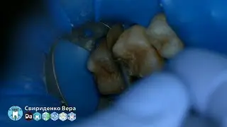 Кариес II-класс 16 PalodentPlus (прямой эфир)