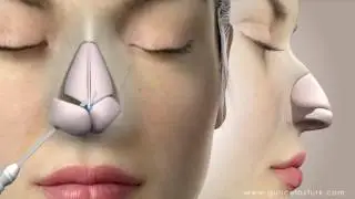 Rhinoplasty (Nose Job) Video Animation - Guncel Ozturk, MD - 