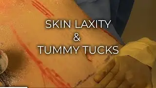 Skin Laxity & Tummy Tucks | What We Asses | Galanis Plastic Surgery
