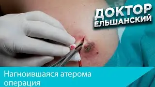 Нагноившаяся атерома операция