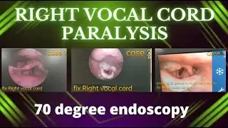 Right vocal cord paralysis | fix right vocal cord | 70-degree endoscopy