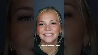 Meet Lainey! 4 upper Prep-Less Porcelain Veneers for an incredible transformation! 🤩#shorts