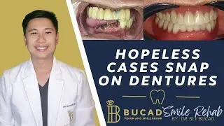 Hopeless Cases Snap on Dentures. Best Dental Optical Clinic Manila Philippines
