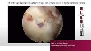 RIWOspine Full-endoscopic Spine Surgery at Cervical Spine - posterior approach