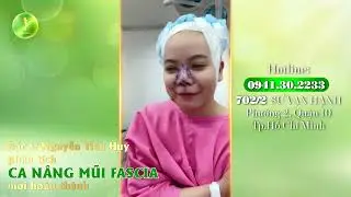 Khách hàng lột xác hoàn hảo sau ca nâng mũi cấu trúc Fascia