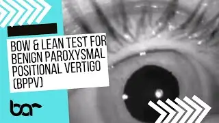Bow and Lean Test Cupulolithiasis