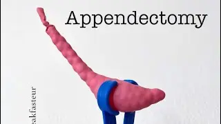 Playdough Surgery 🔪🪱 - Open Appendectomy