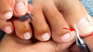 Satisfying Ingrown Toenail Removal | Dry Skin | Pedicure 42