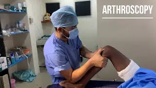 Arthroscopic ACL reconstruction with peroneus longus graft with lateral meniscus repair #kneepain