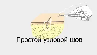Простой узловой шов