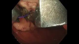 Apollo OverStitch Sx TM for closure of a gastric wall defect.
