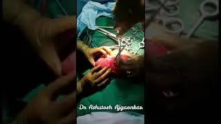 Caesarean myomectomy-