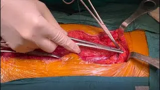 Incisional hernia prevention after midline laparotomy and ileostomy reversal – a video vignette