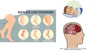 RESTLESS LEG SYNDROME