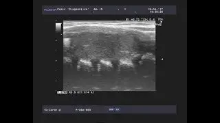 Video ultrasound - Lateral cyst of the neck on the left