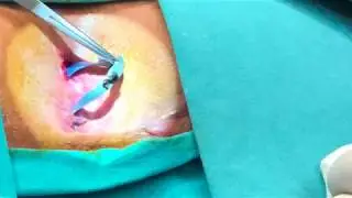 Prof. Dr. Sezai Leventoğlu-Nüks atnalı fistül