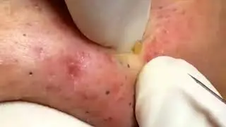 Large Blackheads Removal from Facce