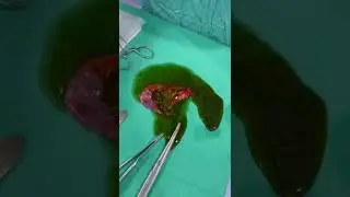 Öd kisəsinin çıxarılması /Laparoskopik xolesistektomiya