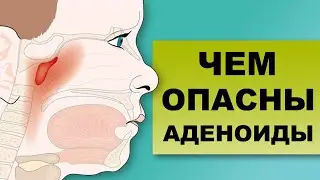 ЧЕМ ОПАСНЫ УВЕЛИЧЕННЫЕ АДЕНОИДЫ?