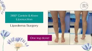 360° CANKLE & KNEE LIPOSUCTION | Lipedema Surgery | Artlipo | Expert Dr. Thomas Su