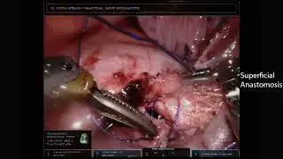 Robotic Sleeve Resection of a Bronchus Intermedius Tumor