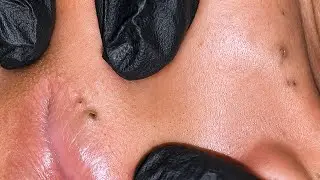 Satisfying Blackhead Removal & Deep Pore Cleansing ASMR (No Talking)