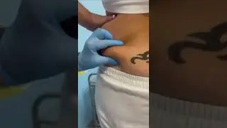 Коррекция фигуры при помощи липолитиков