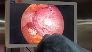 Uterine fibroids treatment by MW ablation