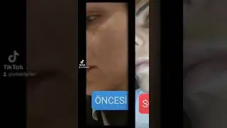 leke kremi setimizden gelen memnuniyet videosu