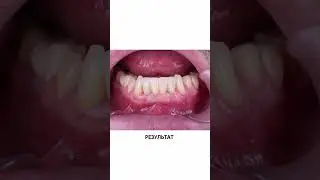 Имплантация передних зубов
