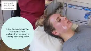 Microneedling treatment using Innopen