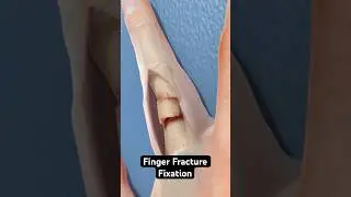 Fixing a fractured finger (3D Animation)
