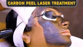 Carbon Peel Laser Treatment | Dr Priyanka Ghatge
