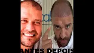 Diogo Nogueira Transplante Capilar - Antes e Depois