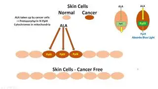 Photodynamic Therapy