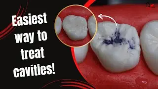 The Easiest Way to Treat a Tooth Cavity! The stamp Technique