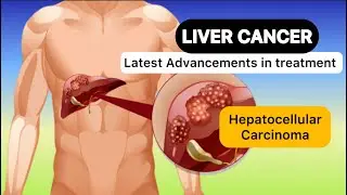 LIVER CANCER (OR) Hepatocellular Carcinoma - LIVER CIRRHOSIS - Causes - Signs Symptoms - Treatment