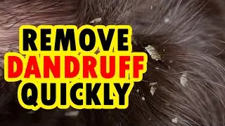 6 Easy Home Remedies To Get Rid Of Dandruff.